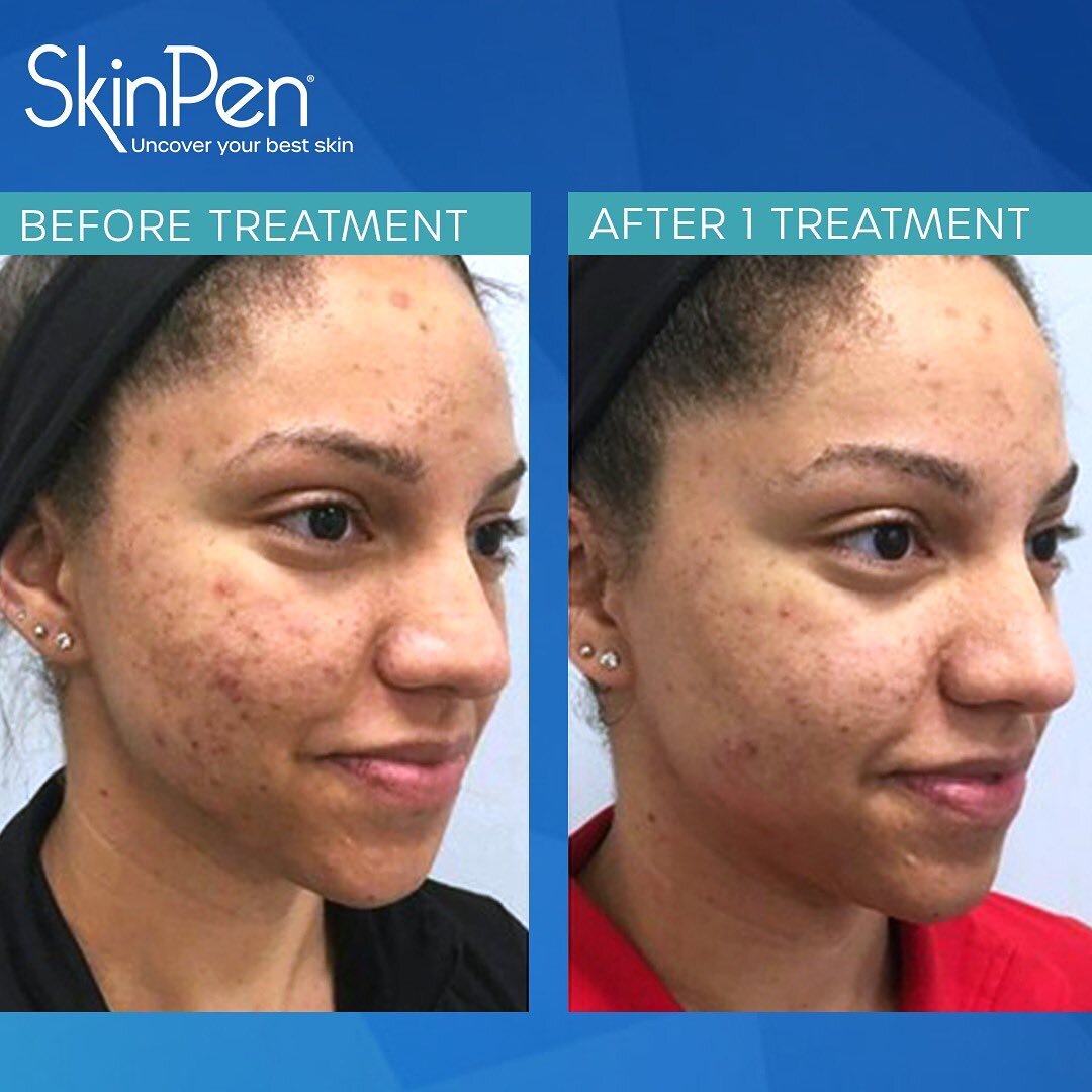 Check out our newest FDA-cleared microneedling device, the 2023 SkinPen 🖊. SkinPen is a simple, comfortable, and effective treatment for skin rejuvenation. It is effective in removing hyperpigmentation, acne scarring, lines &amp; more! Microneedling