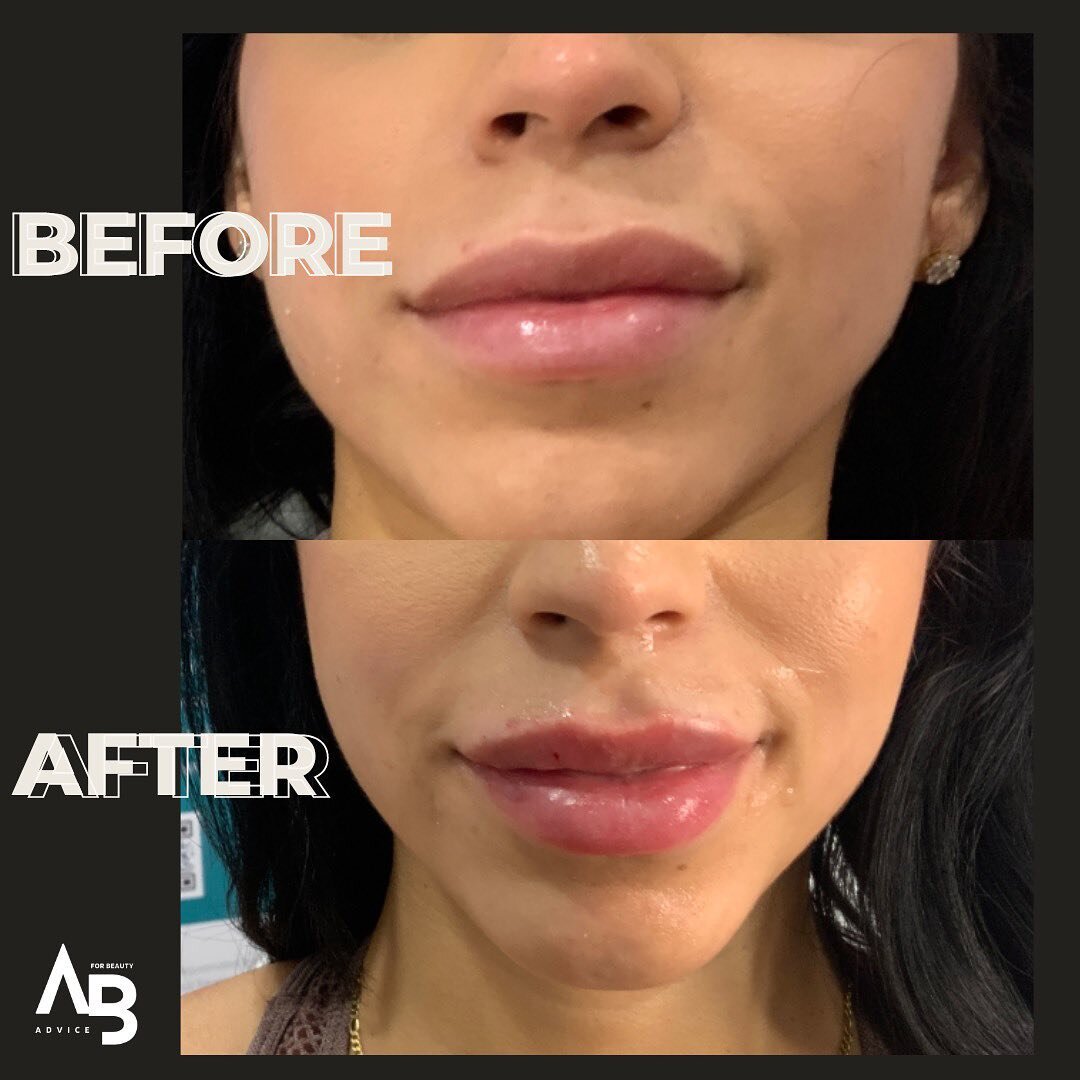 Look at those beauties ✨🫦 

In this case, we fixed the clients top to bottom ratio, add volume to the left side of her lip to create symmetry on the top lip, and added volume to her cupids bow! 

Our patient was very happy with her results!  She wil