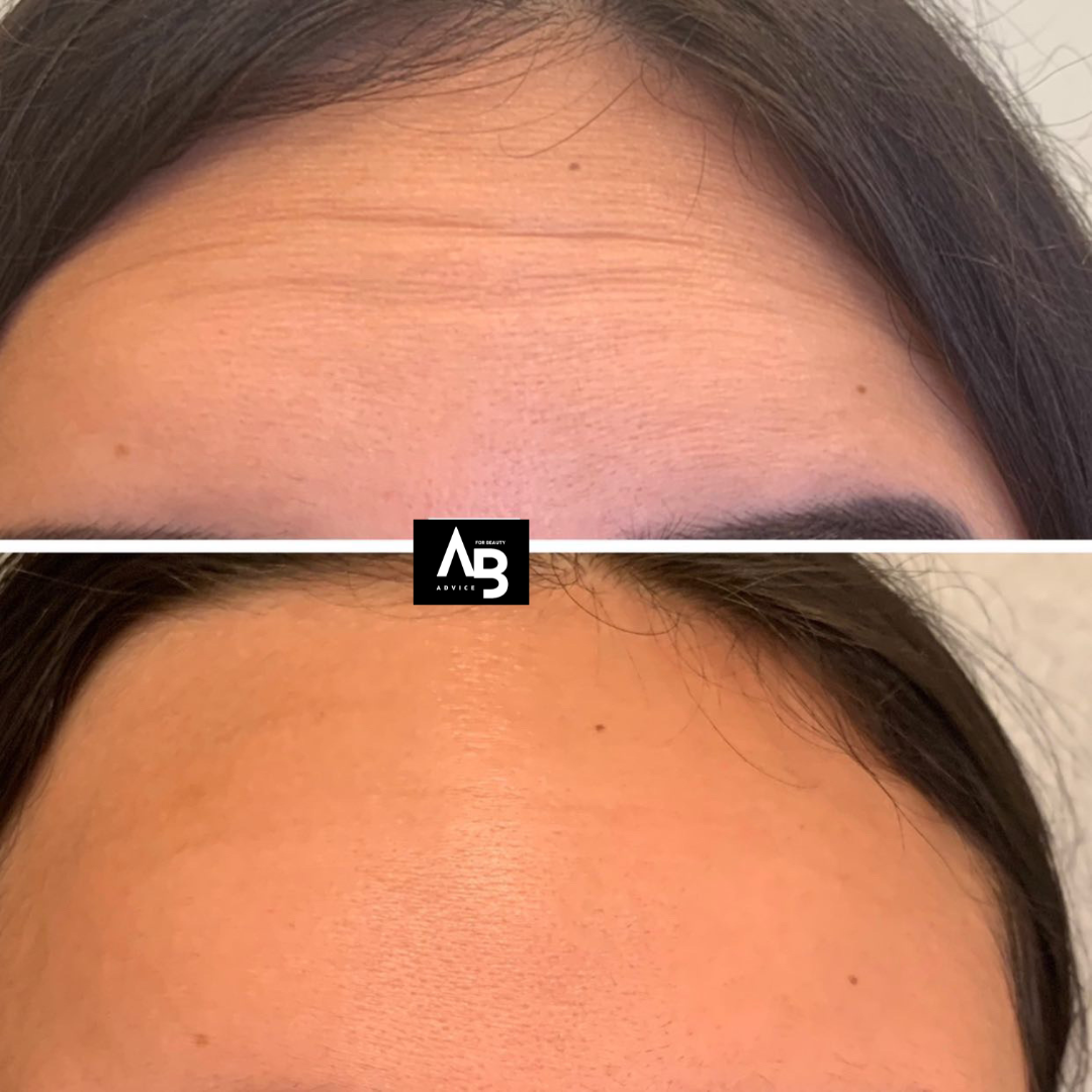 Before & After Botox