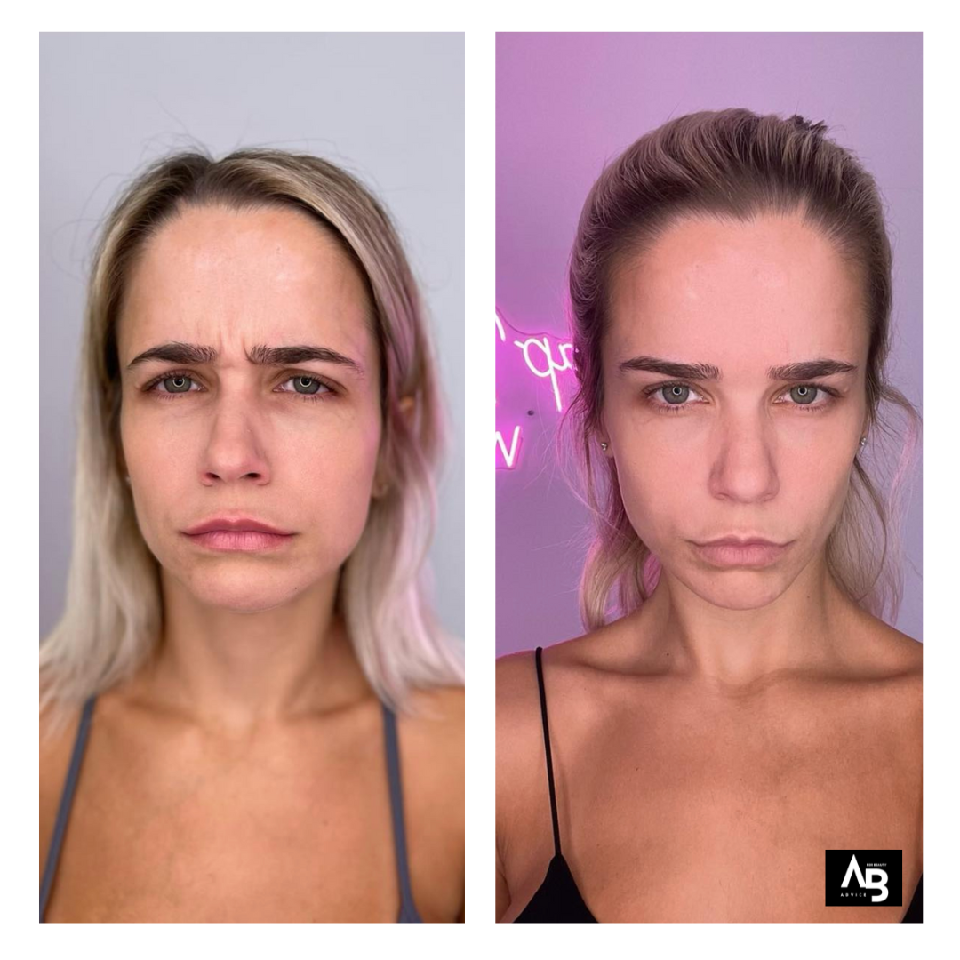 Before & After Botox