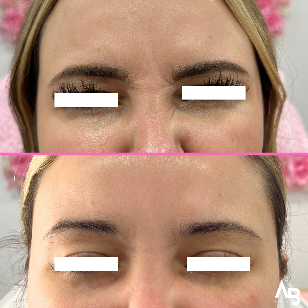 Before & After Glabella Botox