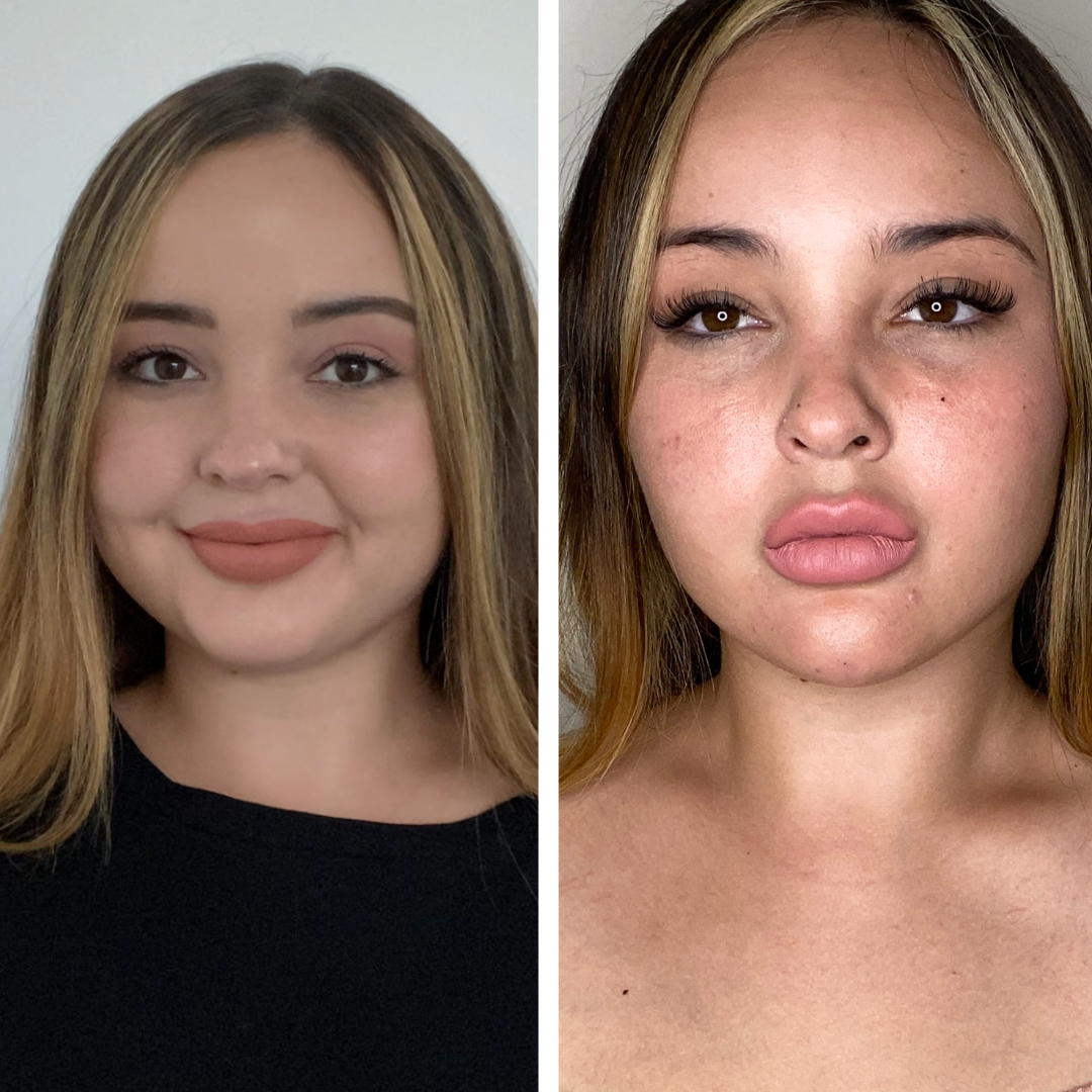 Chin Augmentation & Under Eye Filler