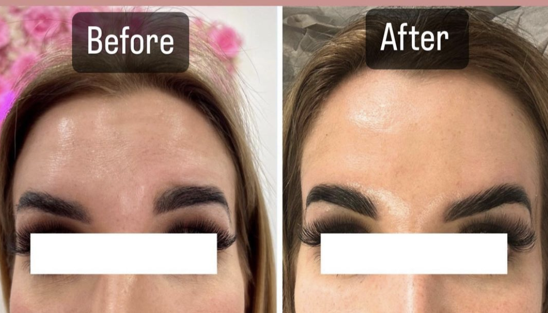 Before & After Botox Brow Lift