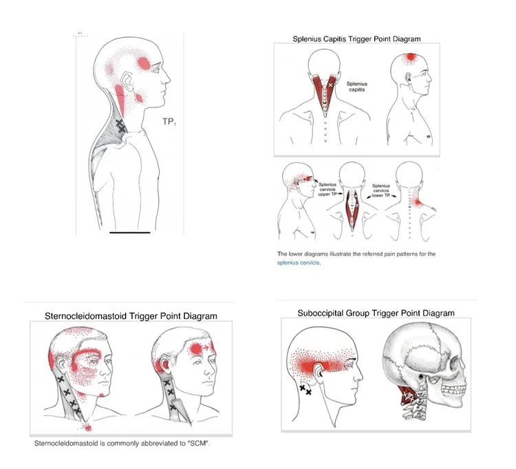 Neuromuscular Therapy Green Bay – Headache Relief Solutions