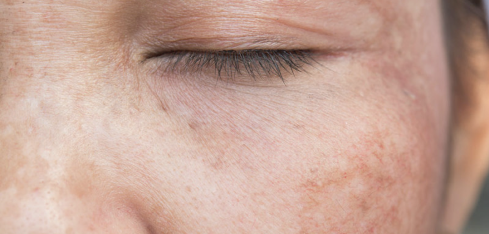 IPL vs BBL vs Laser — Why Lumecca Is the Gold Standard for Pigment and Redness