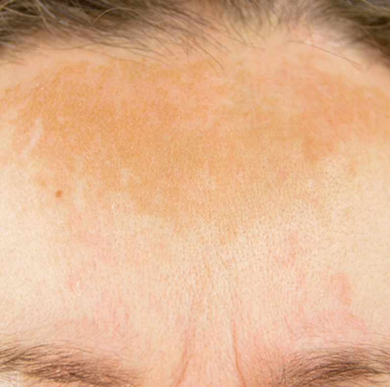 Can IPL Fix Sun Damage Permanently? The Honest Answer