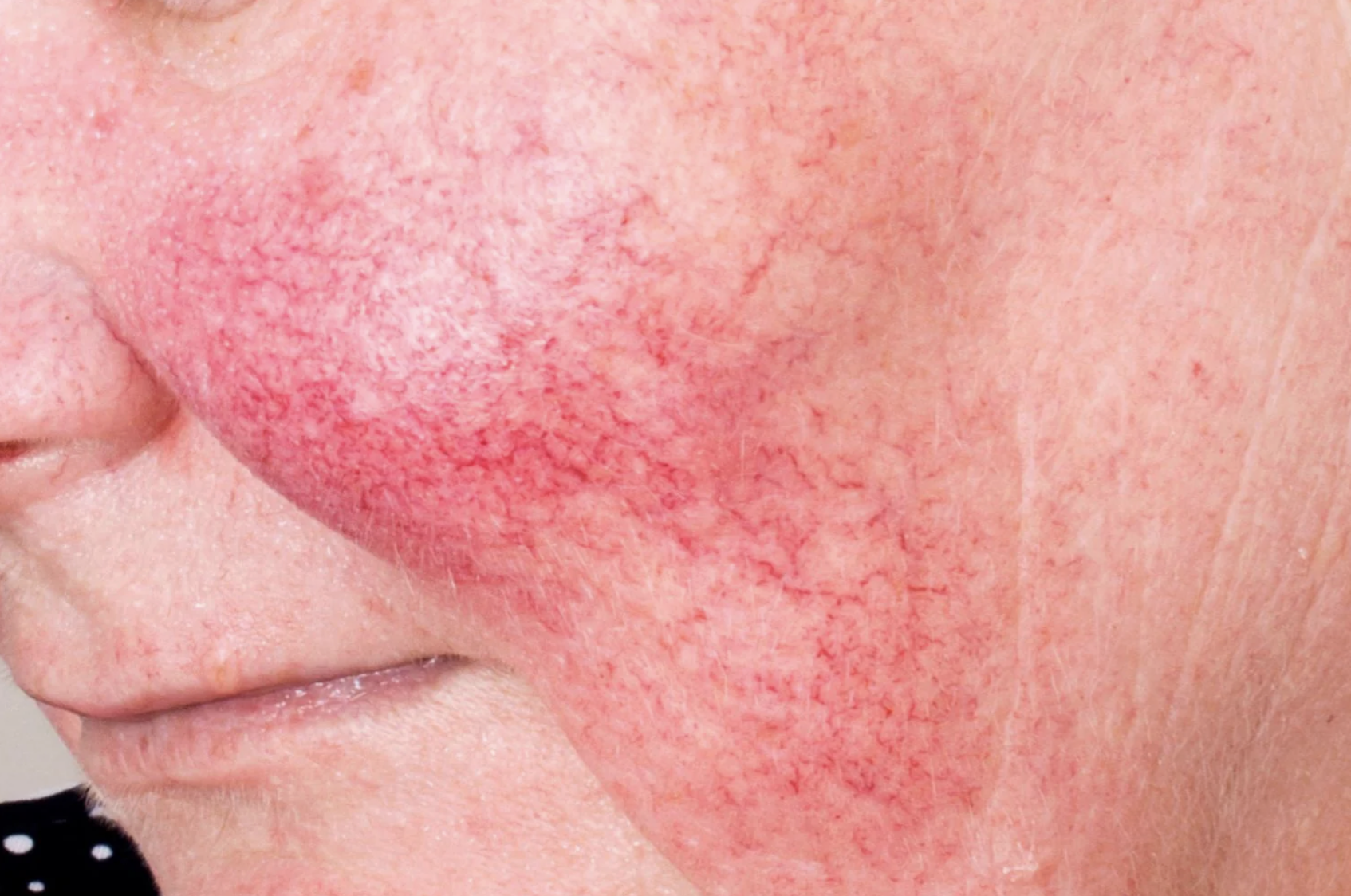 IPL for Rosacea and Redness — Why Prescription Creams Aren’t Enough