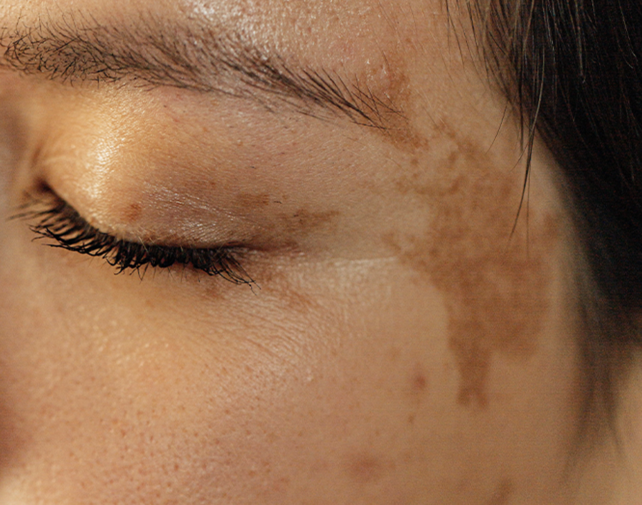 IPL vs. Chemical Peels — Which Is Better for Discoloration?