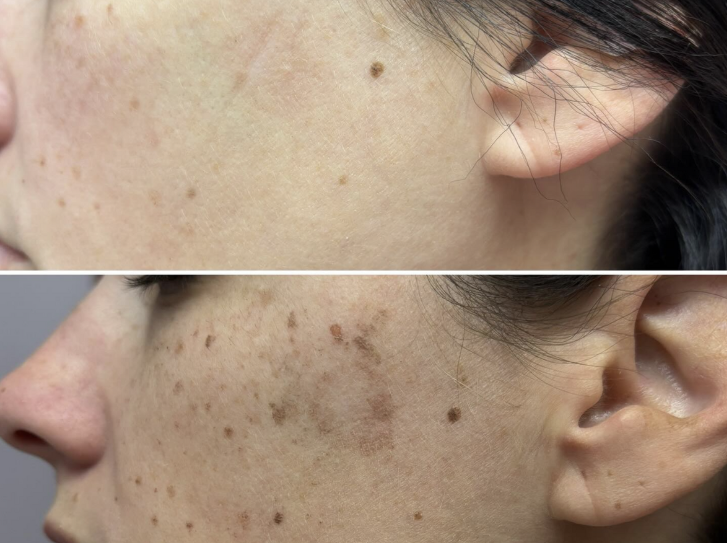 Can IPL Be Done on the Neck, Chest, and Hands? Not Just the Face