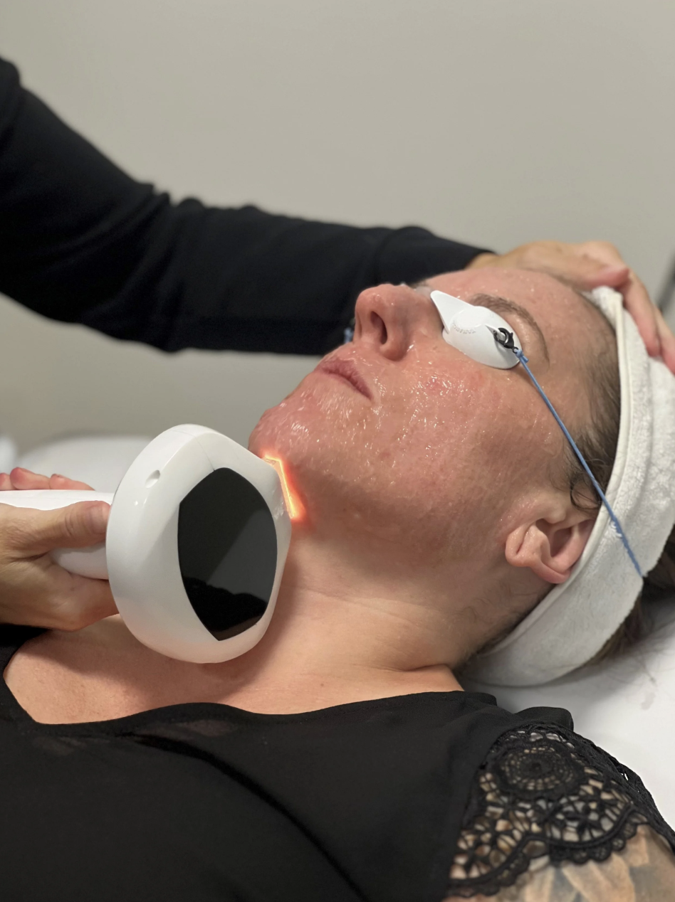 IPL for Red Acne Scars and Post-Inflammatory Redness