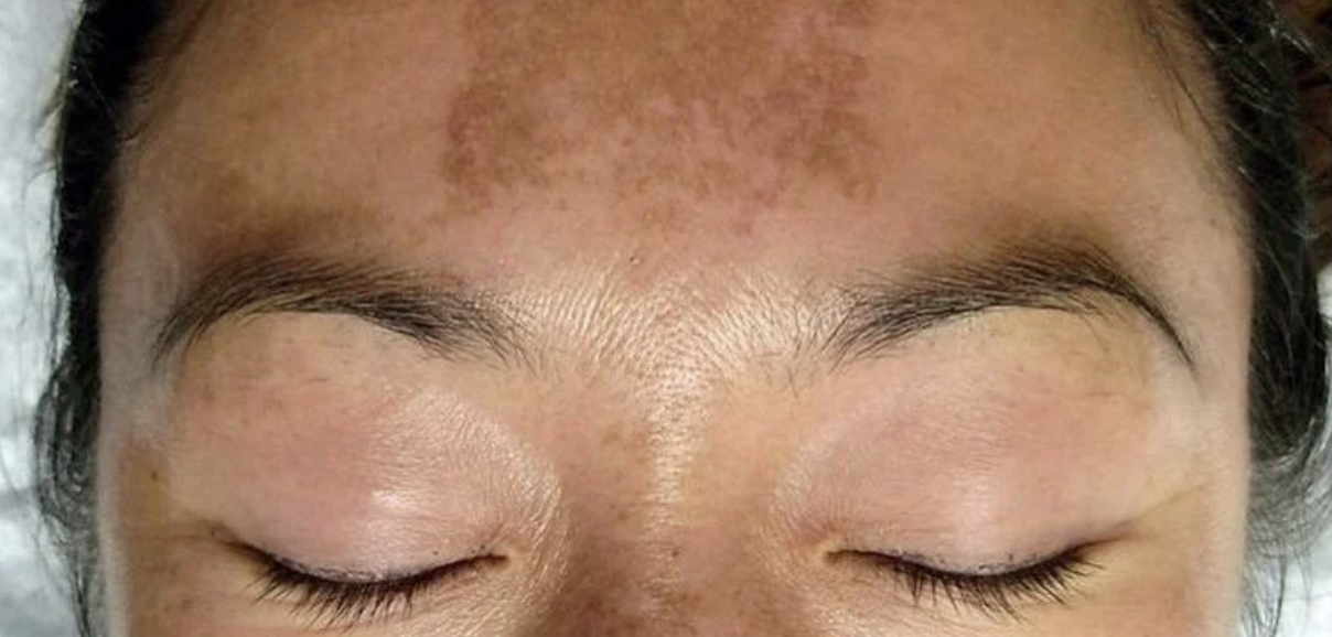 IPL vs Laser for Brown Spots — Which One Wins for Your Skin Type?