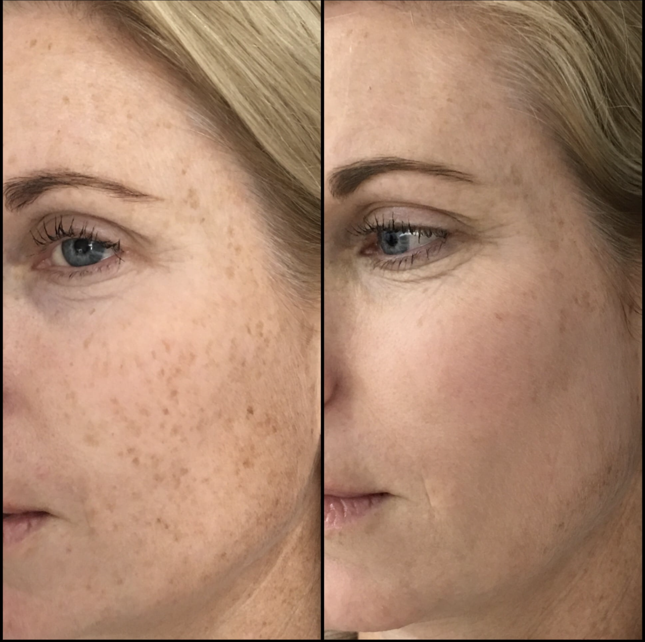 High-End IPL vs Groupon IPL — The Safety and Result Difference Nobody Talks About