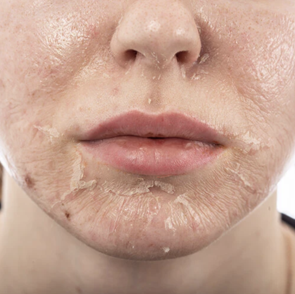 CoolPeel vs. Chemical Peel for Pigmentation: Which One Really Works?