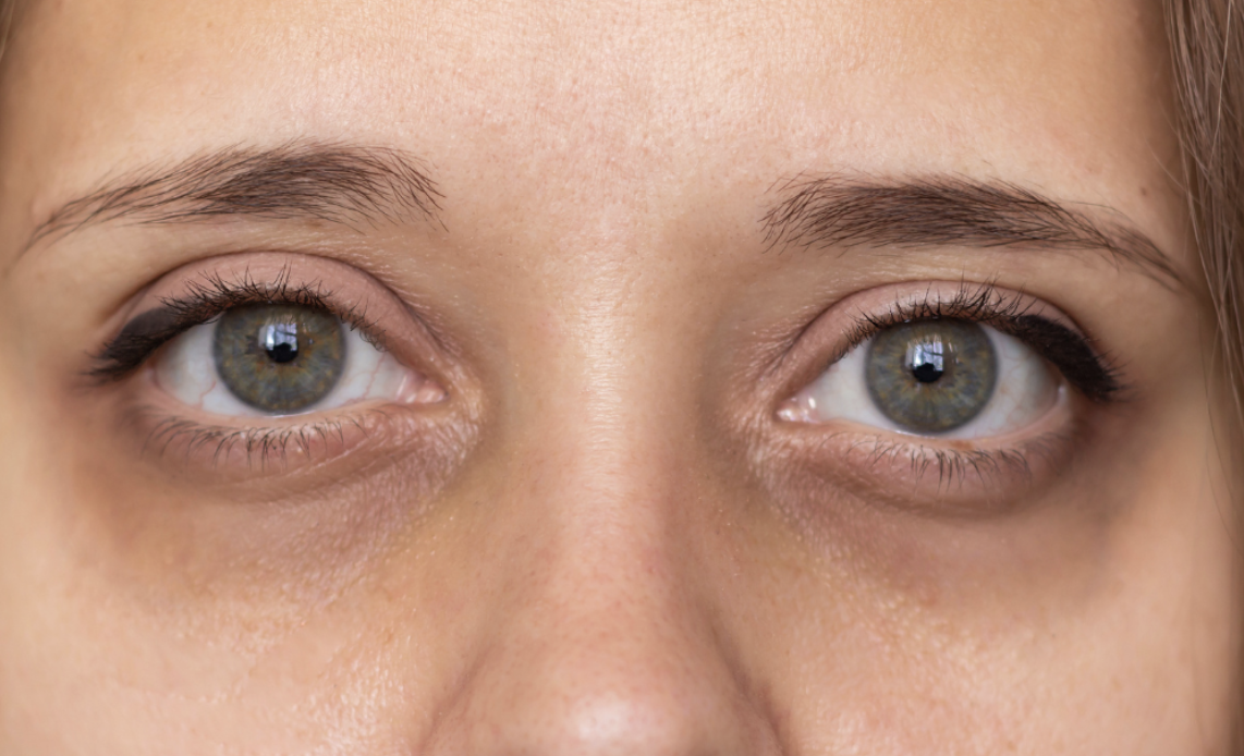 Say Goodbye to Dark Circles: Tips and Treatments for Brighter Eyes