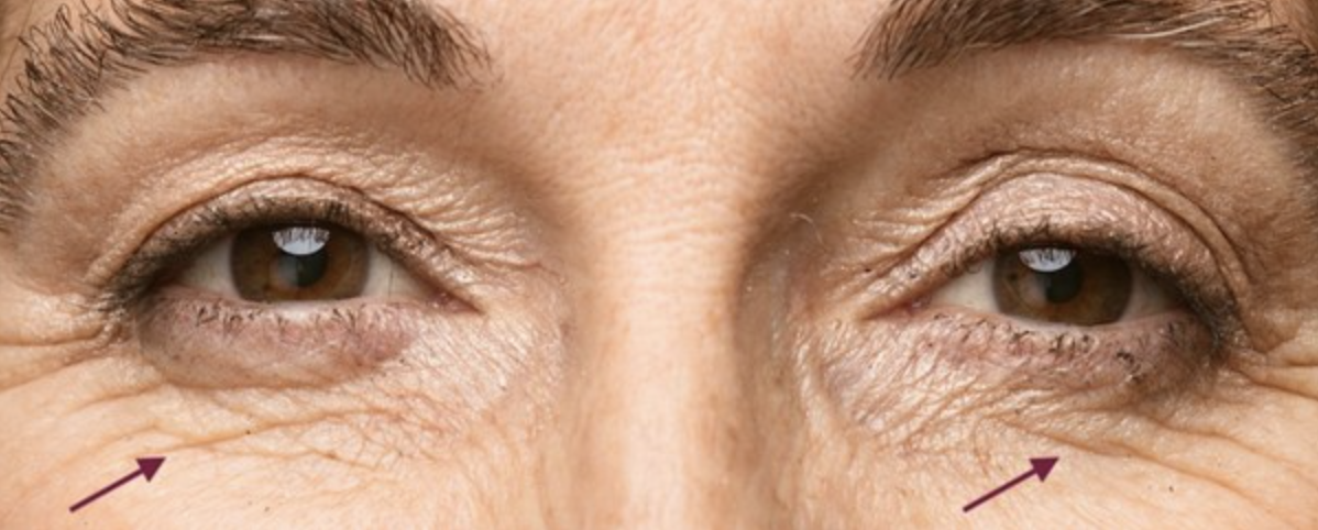 Fine Lines Under Your Eyes? Treatments That Restore Youthful Skin