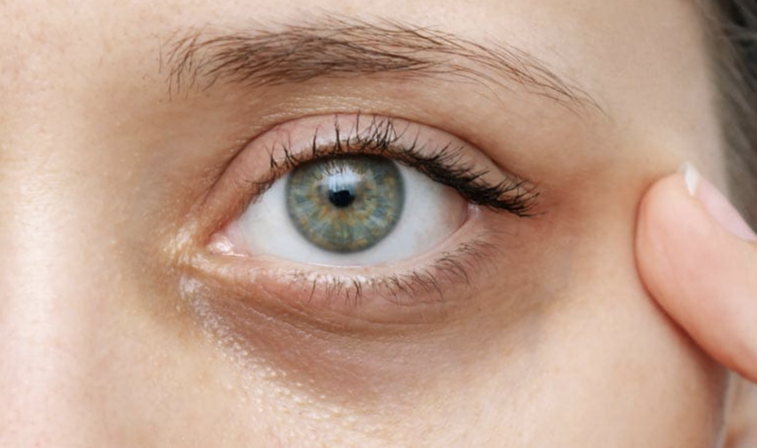 Why You Have Dark Circles and How to Treat Them at Core Aesthetic