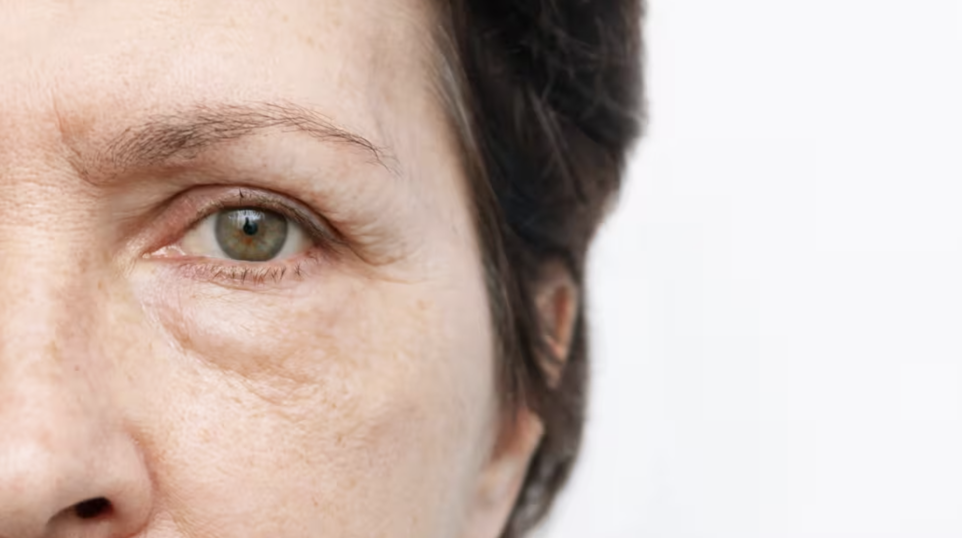 Under-Eye Bags: Causes, Treatments, and Prevention Tips