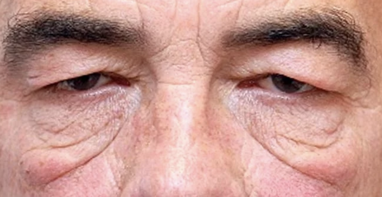 From Puffy to Perfect: How to Reduce Eye Bags and Sagging Skin