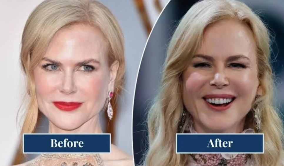 Why Overfilled Faces Happen (And How HA Filler Should Look Instead)