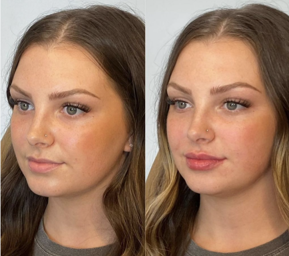 HA Filler for First-Timers: What to Expect