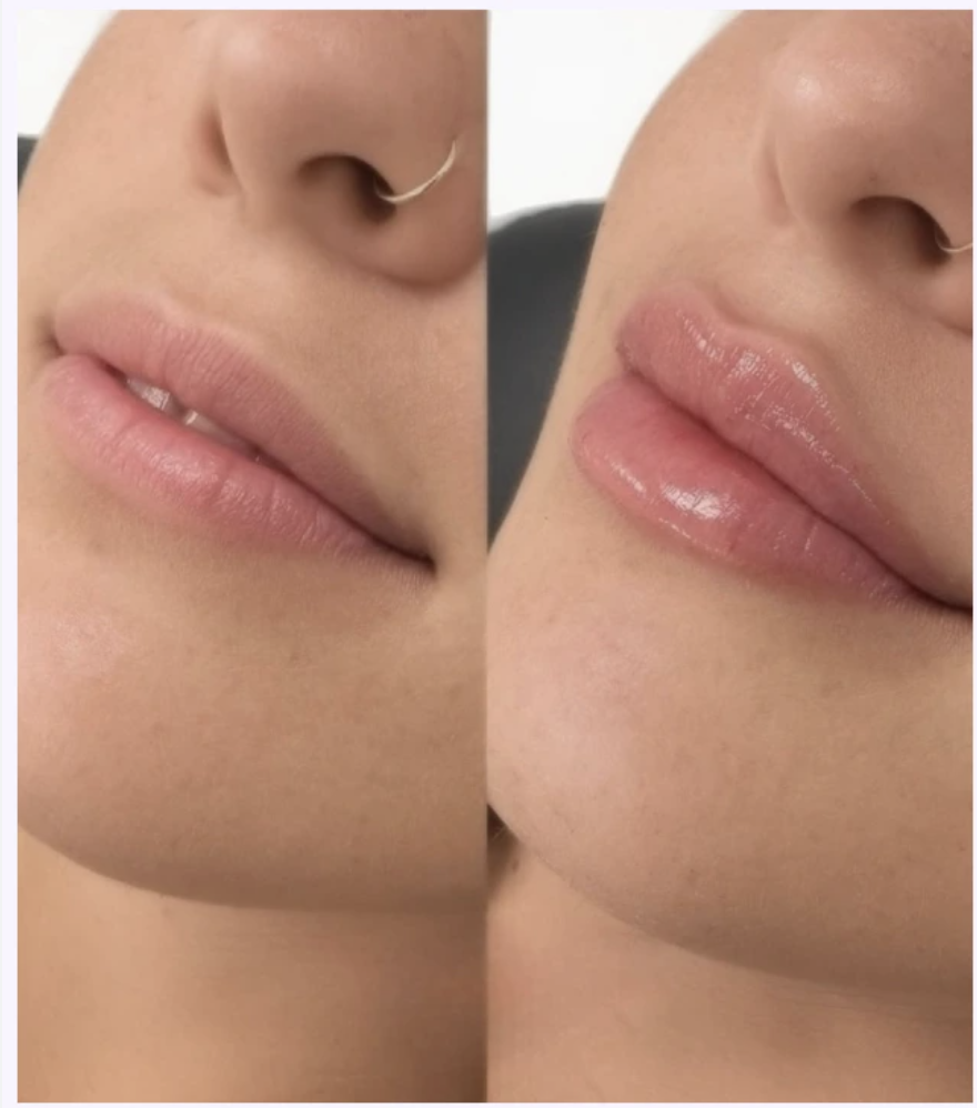 Lip Filler 101: Shape, Structure, and Safety