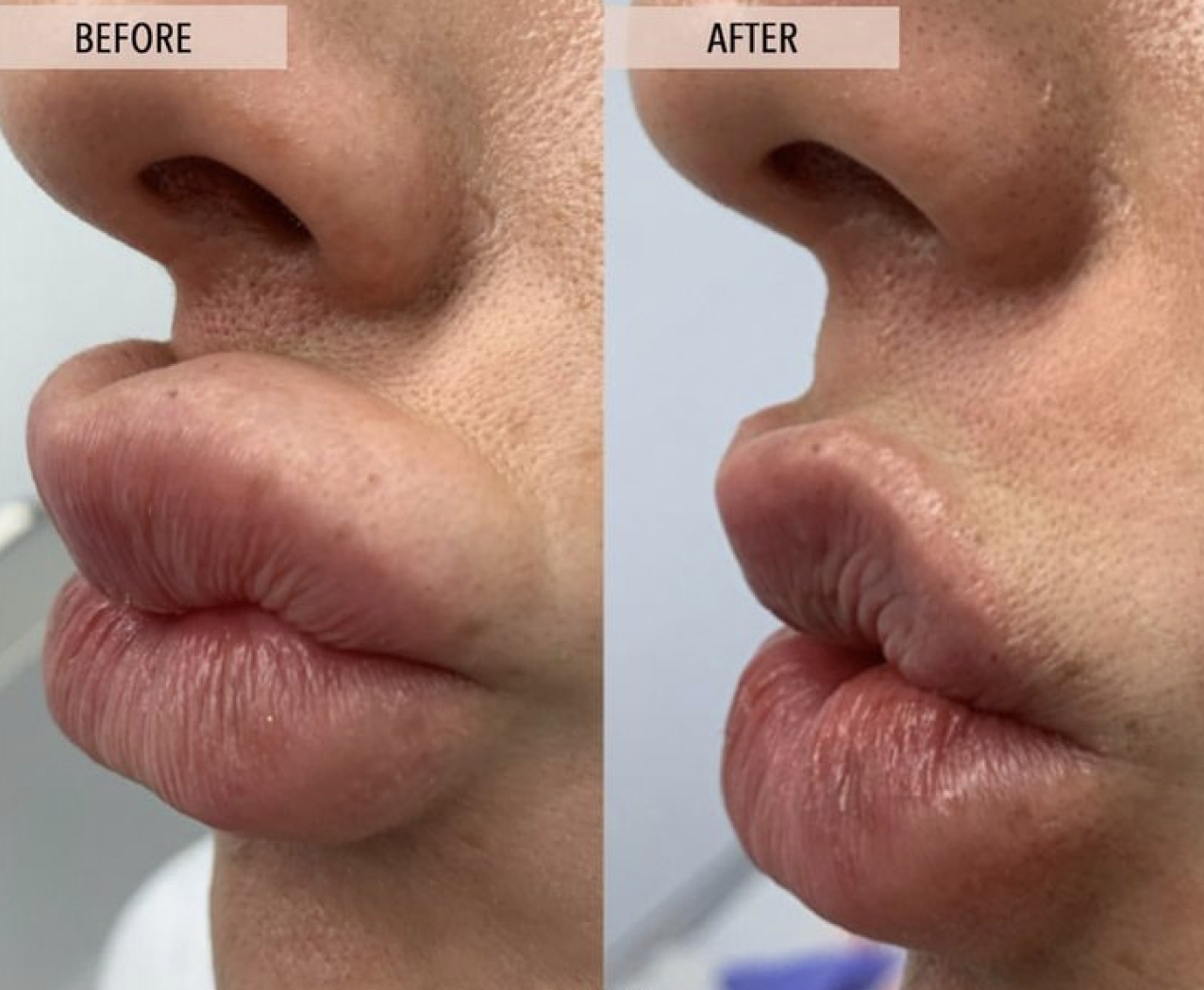 Can HA Filler Be Dissolved? What You Need to Know