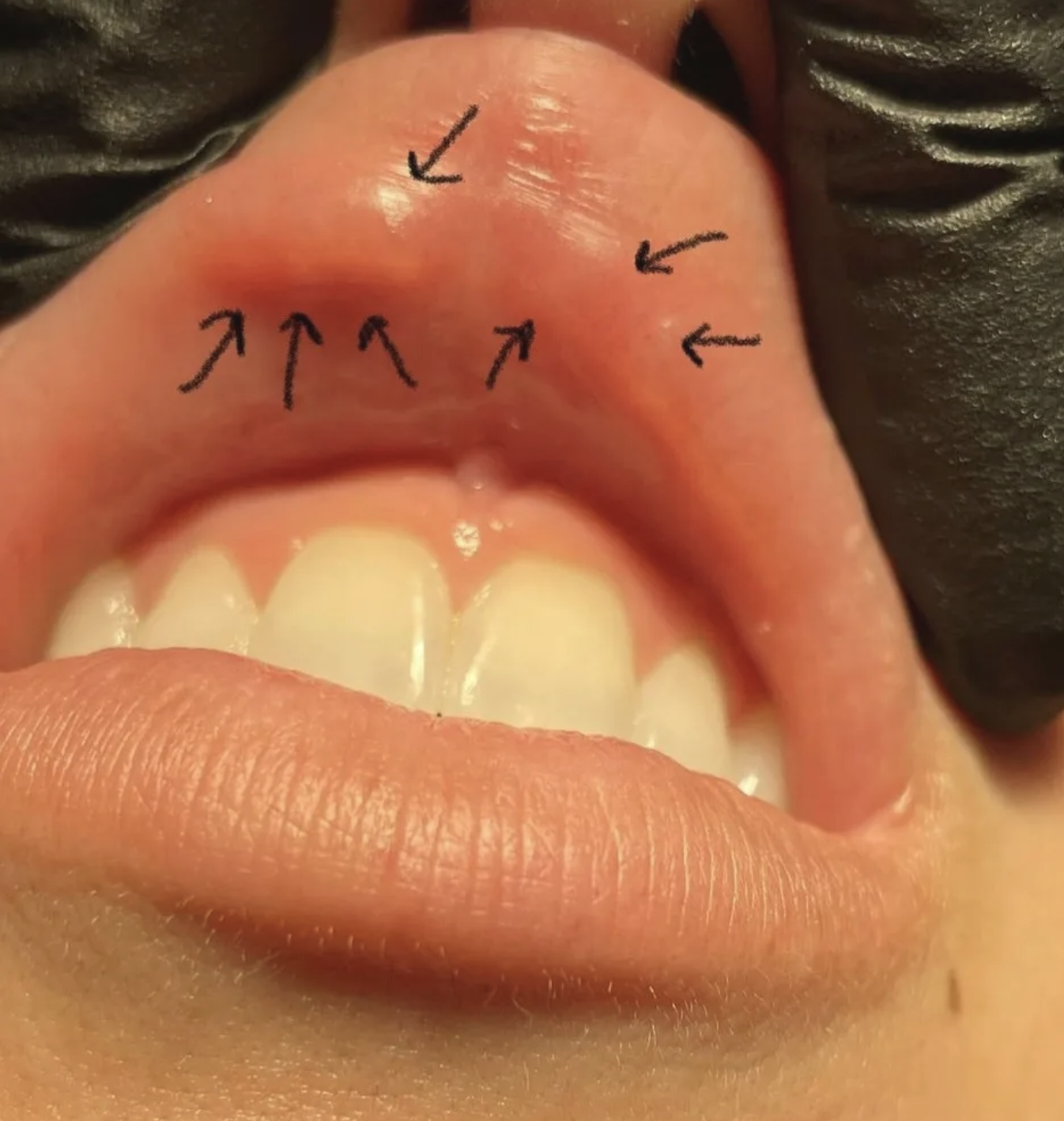 Filler Migration: Why It Happens and How We Prevent It