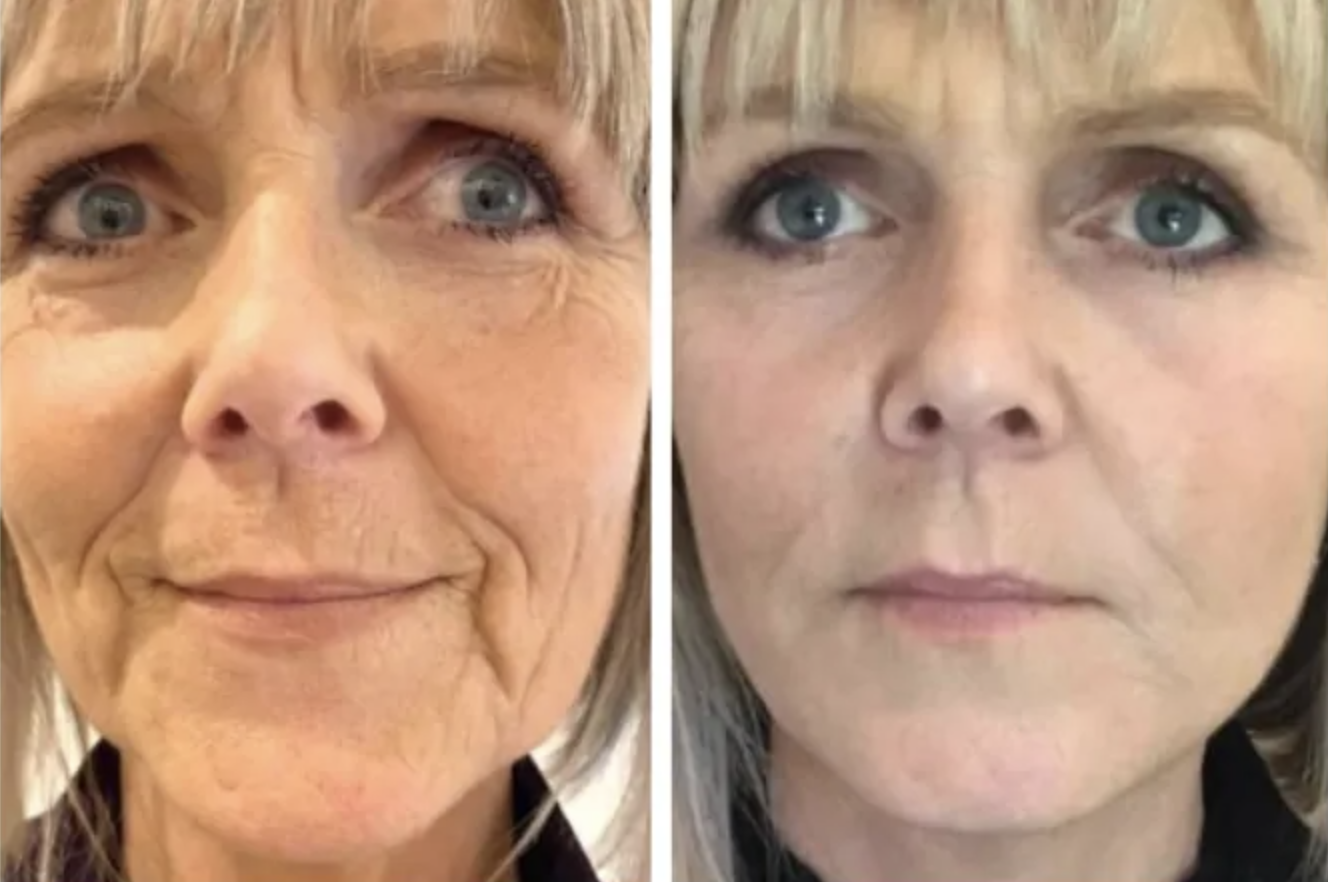 HA Filler After Weight Loss: Restoring Balance