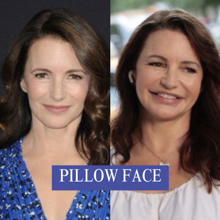 Why More Filler Is NOT Better