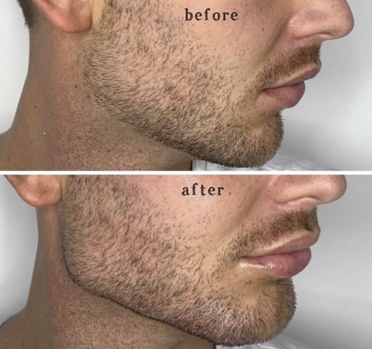 HA Filler for Men: Structure Over Softness