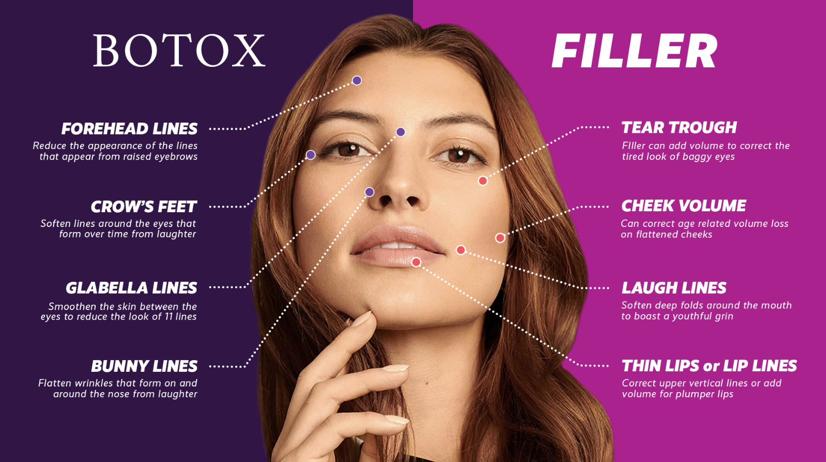 Filler + Botox: Why Timing and Order Matter for Natural, Long-Lasting Results