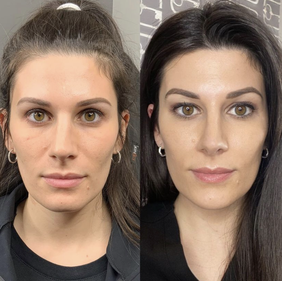 The Best Age to Start Sculptra (And Why Waiting Can Cost You)