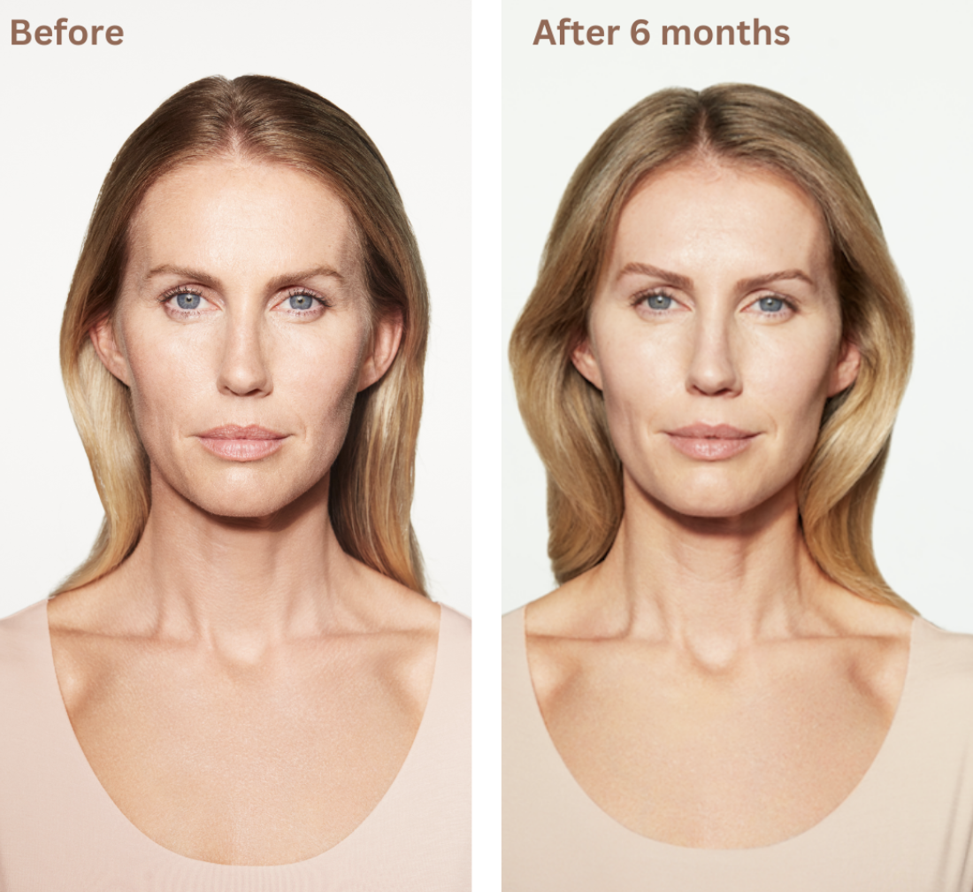 Why Sculptra Is the Gold Standard for Long-Term Facial Rejuvenation