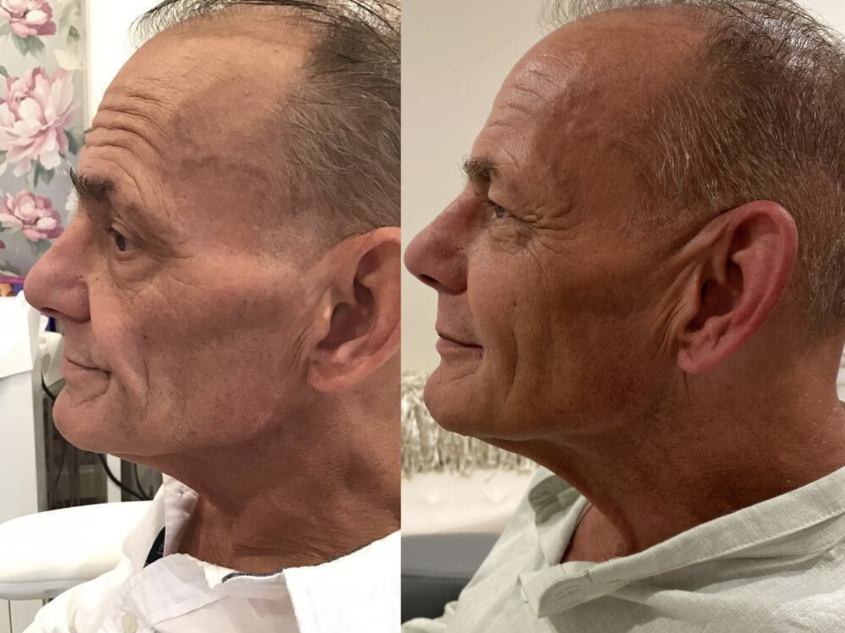 Sculptra for Men: Why More Men Are Choosing Collagen Over Filler