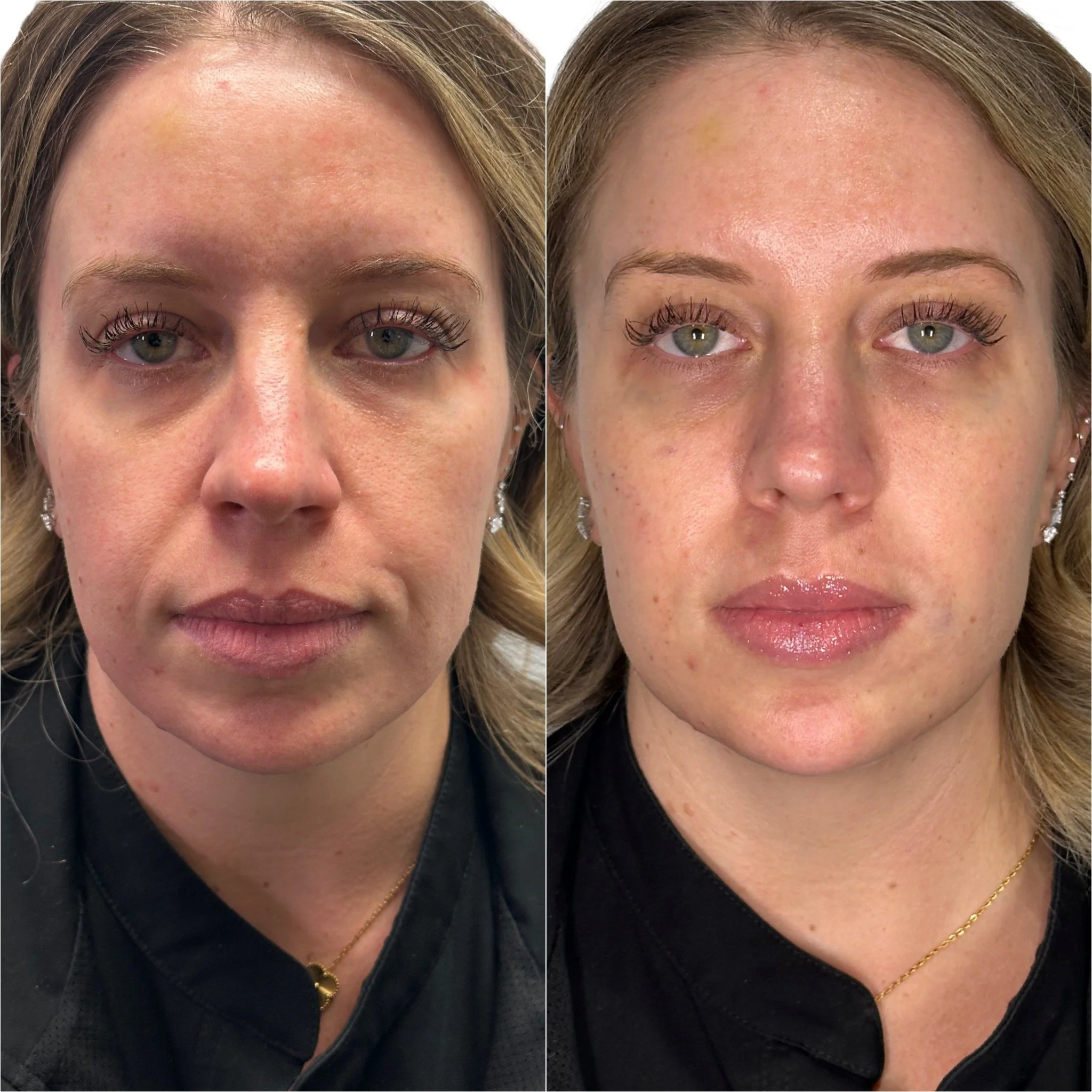Facial Balancing with HA Filler: Why It’s Not About “More Filler,” It’s About Better Proportions