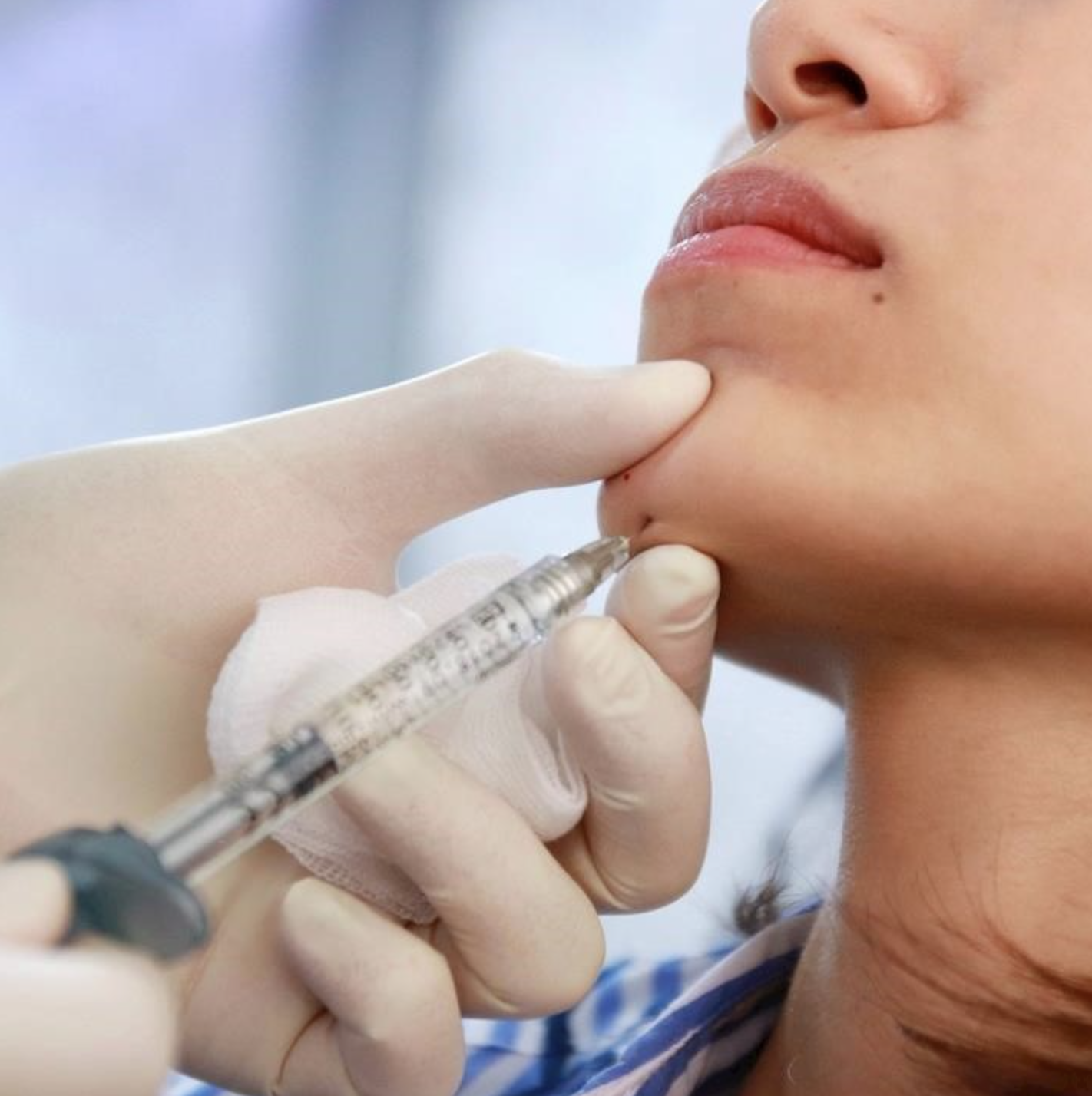 Not Just Lips and Cheeks: How Facial Balancing with HA Filler Enhances the Entire Face