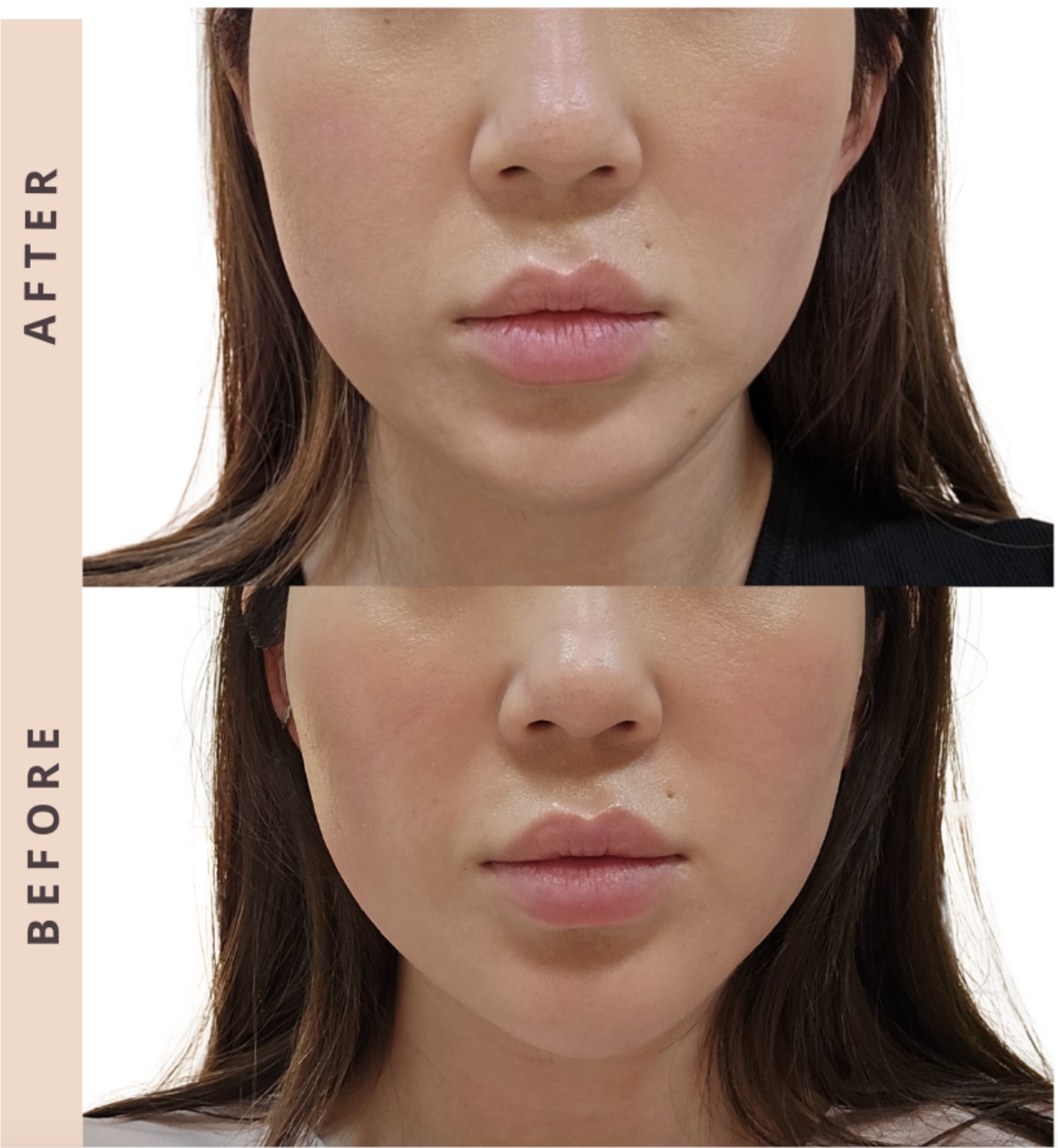 What Makes Everesse Different? A New Era of Non-Invasive Skin Firming