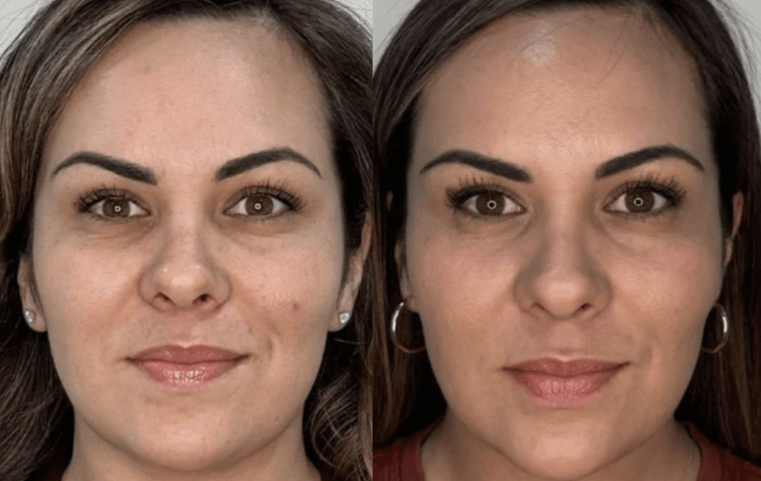 Instant Lift, Zero Downtime: How Everesse Delivers Real Results