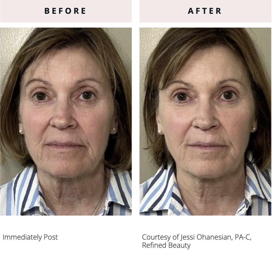 The Technology Powering Everesse: Advanced Skin Tightening Explained