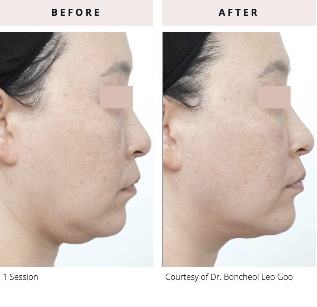 Why Everesse Is the Go-To Treatment for Natural-Looking Lift