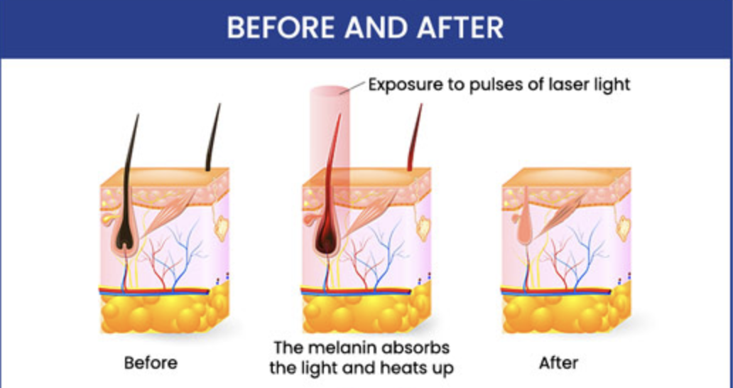 Why Hair Grows Back After Laser Hair Removal—and How to Prevent It