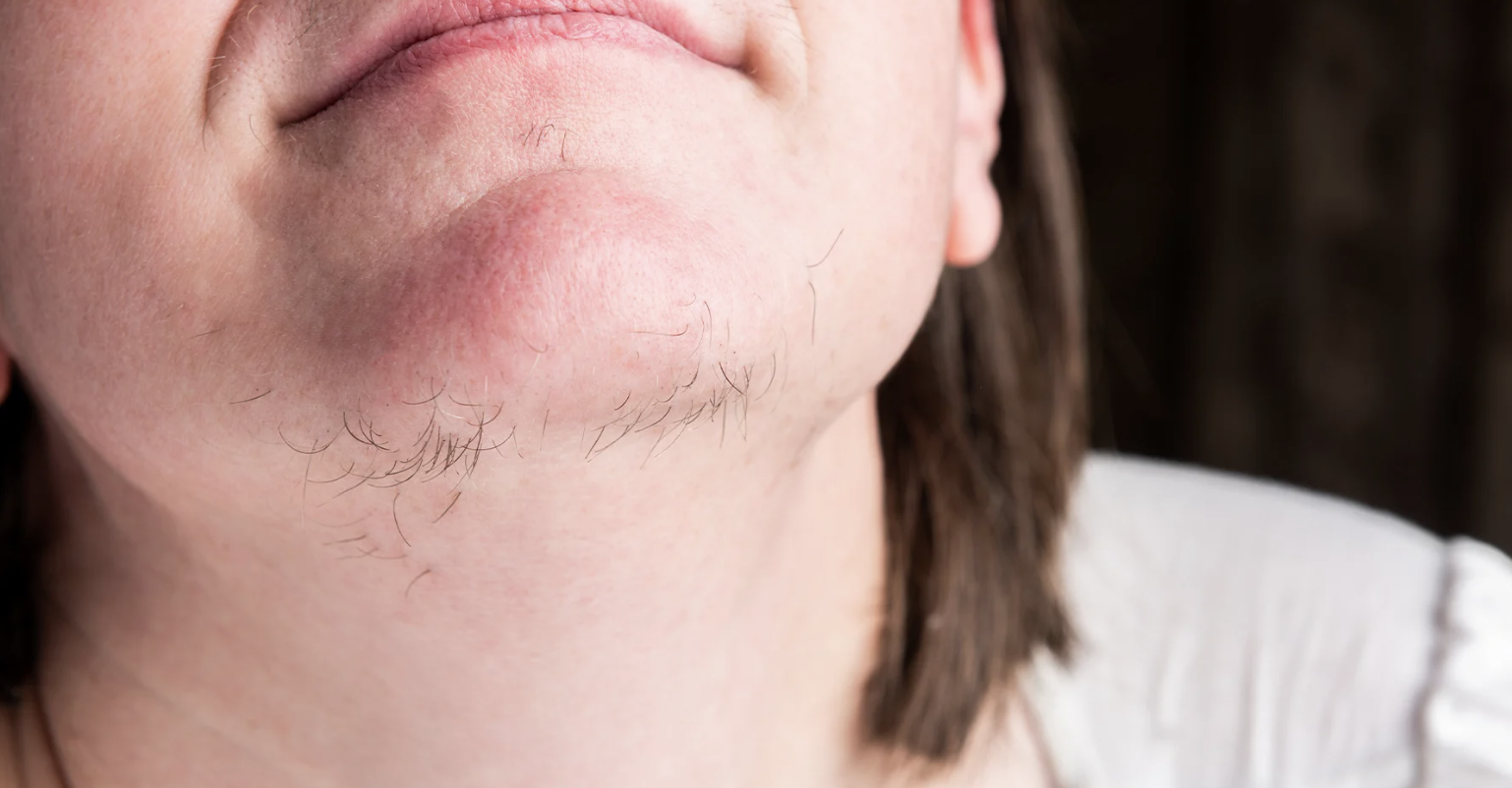 Is Laser Hair Removal Safe During Hormonal Changes or PCOS?