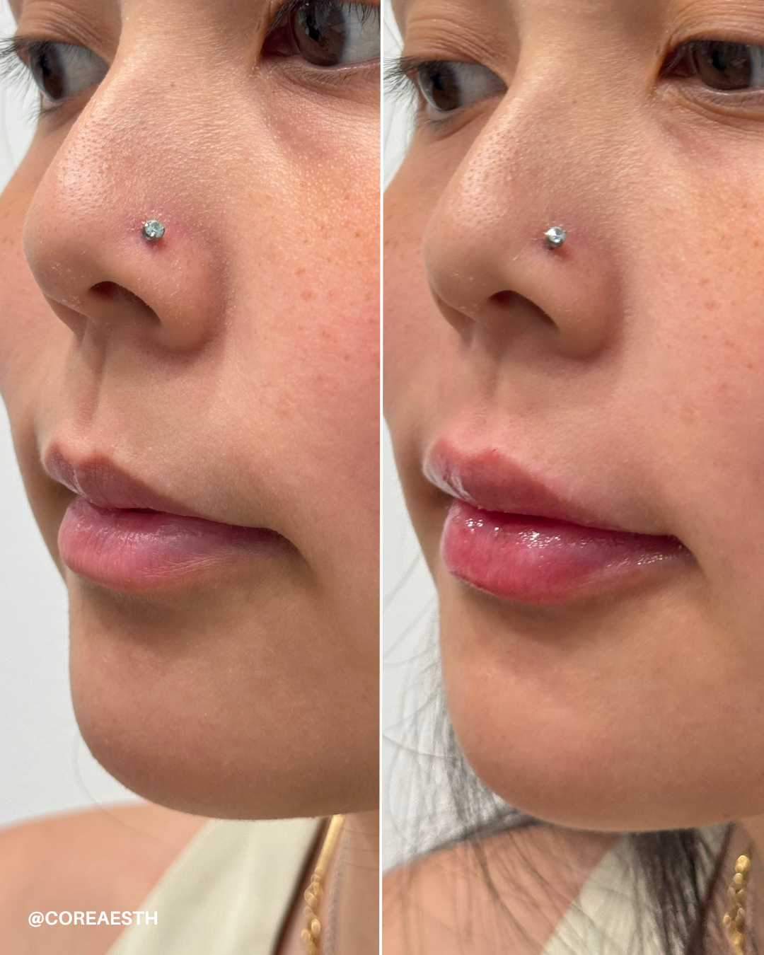 Before and after image of lip enhancement with glossy finish on a person's lips, focusing on a nose piercing.