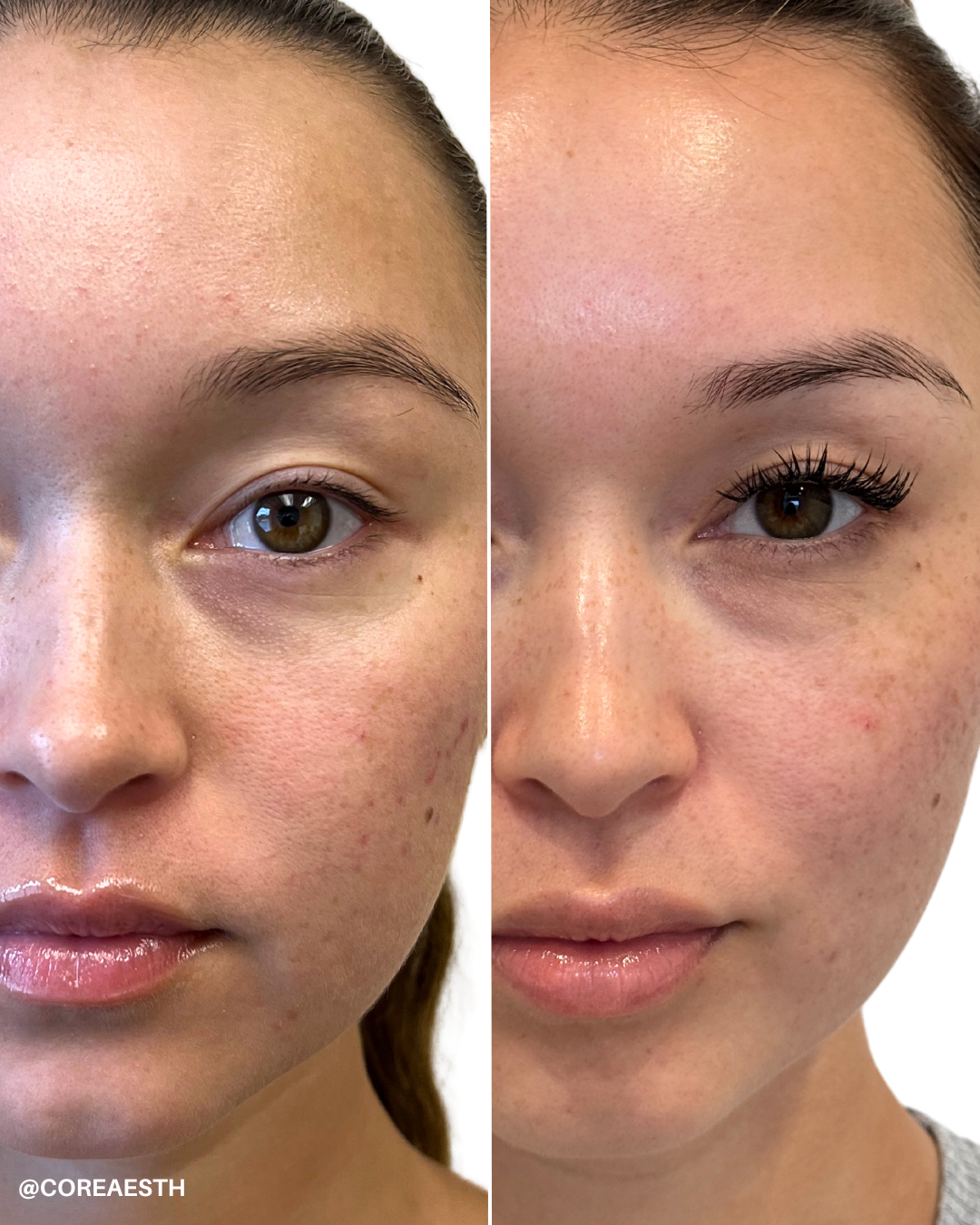 Side-by-side comparison of a woman's face showing before and after results of a beauty treatment. The 'before' image shows natural lashes, subtle acne marks, and minimal makeup, while the 'after' image shows enhanced lashes, smoother skin, and a more polished look.