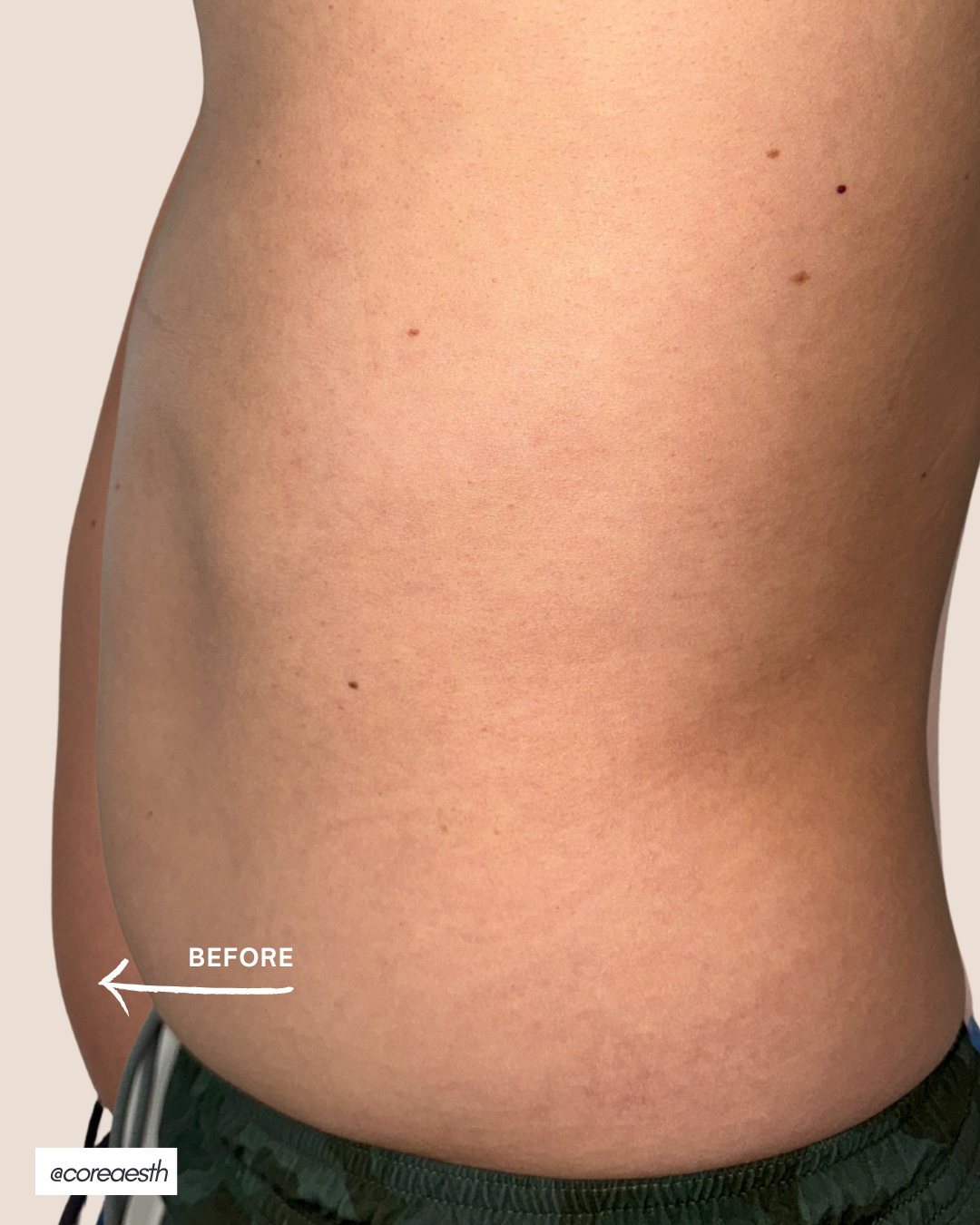 Side profile of a person’s torso showing the before state of the abdomen area.