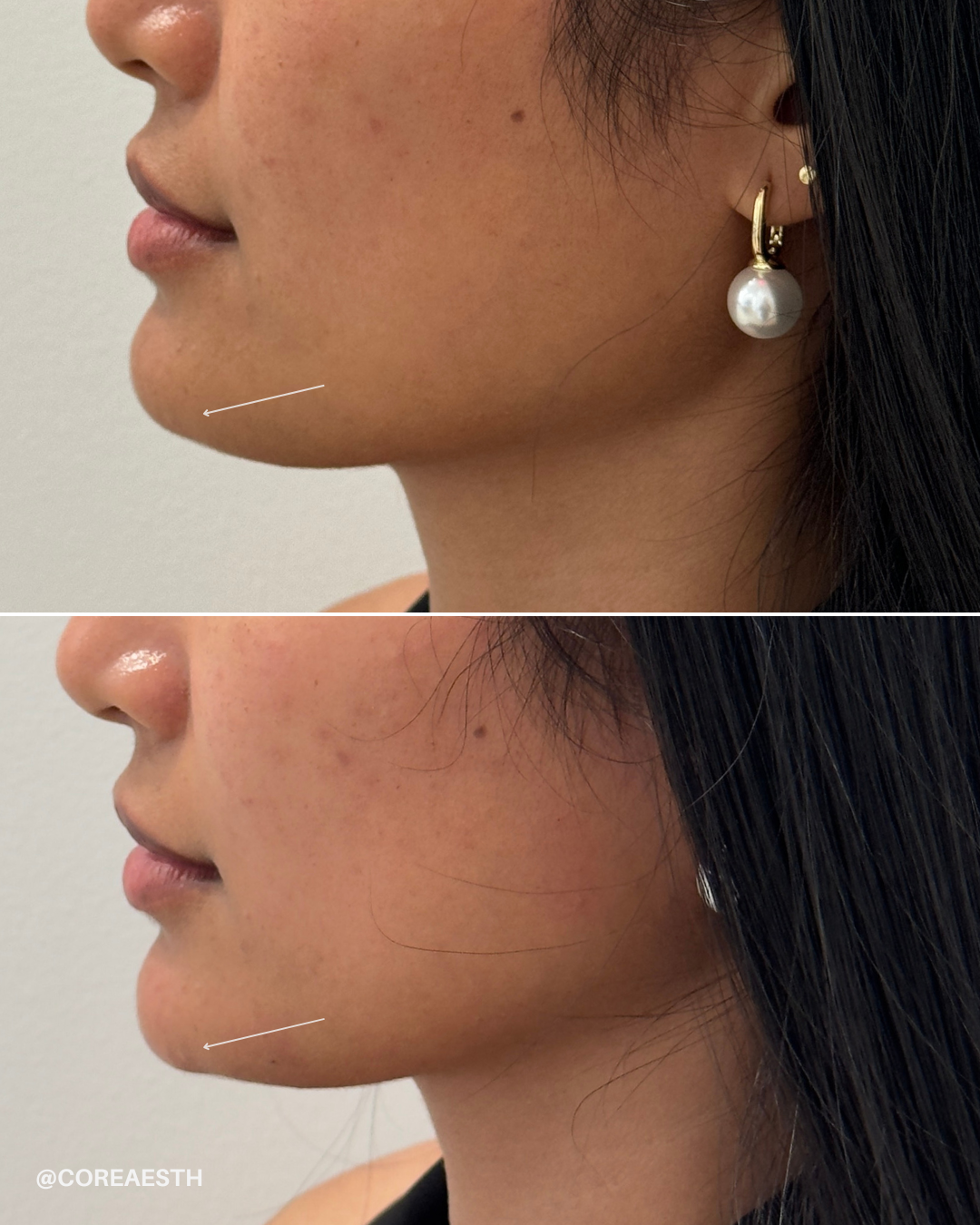 Side profile of a woman showing a before and after comparison of her jawline and chin, with subtle contour changes indicated by arrows.