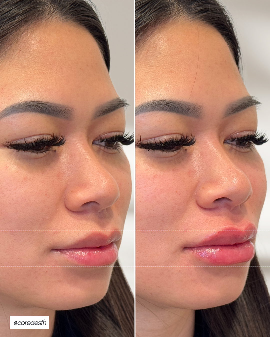Side-by-side comparison of a woman's face before and after a cosmetic procedure, showing enhanced lips.