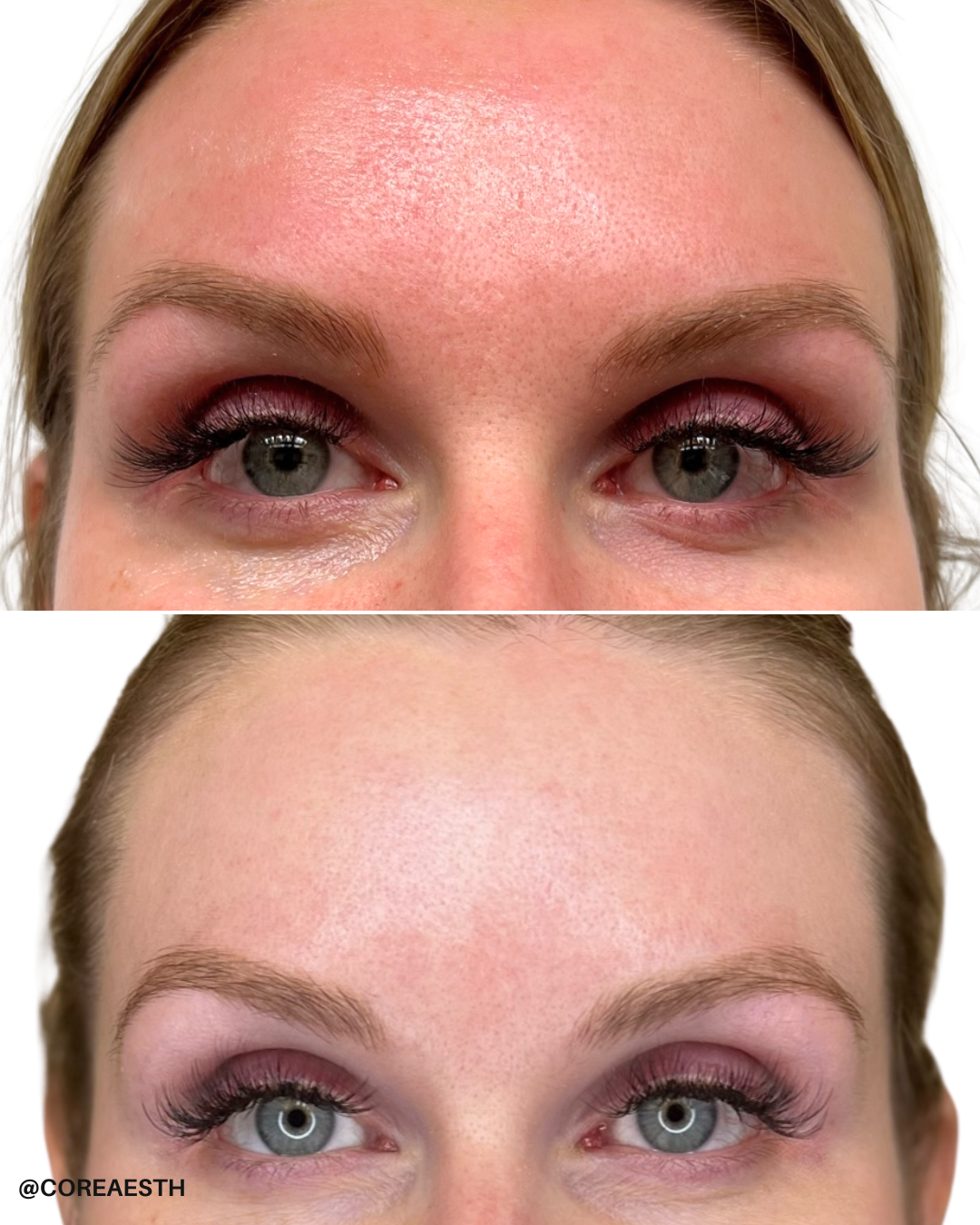 Two photos showing a close-up of a woman's forehead and eyes. The top photo displays some redness and dilated pores on the forehead. In the bottom photo, the forehead appears smoother and less red.