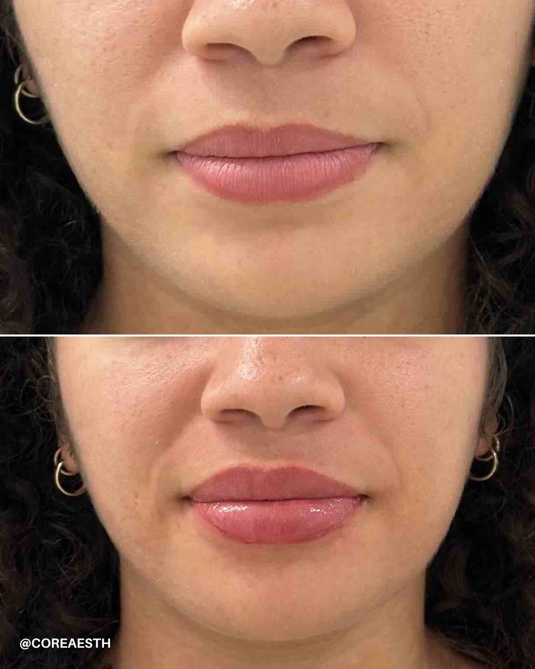 Before and after lip transformation, showcasing natural and fuller lips.