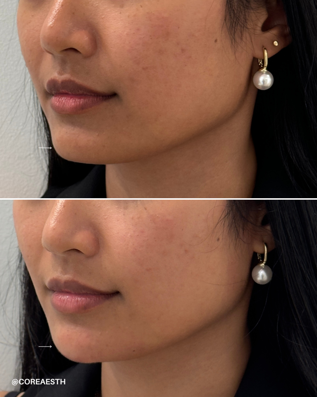 Before and after collage of a woman's face, highlighting skin texture improvement. Close-up shots focus on the lips, cheek, and ear with pearl earring.
